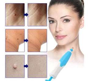 Kit Ferramenta Removedor de Verrugas 2 em 1 Skin Tag