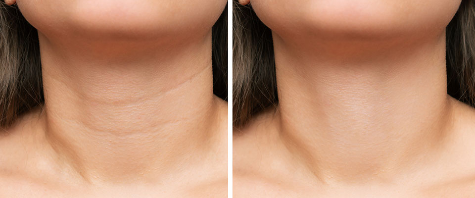 Caneta Lifting Instantânea - Trend+